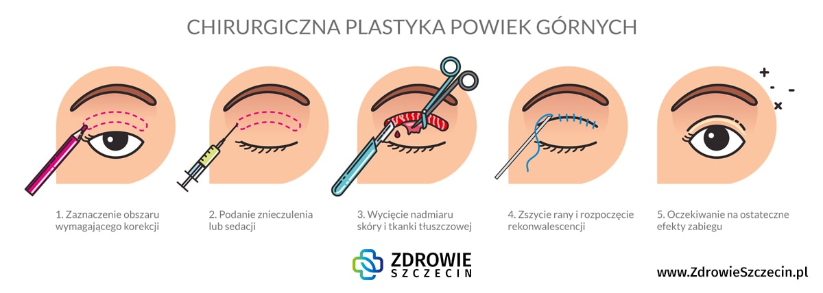 Plastyka powiek górnych Szczecin, chirurgia plastyczna Szczecin, chirurg plastyk Szczecin
