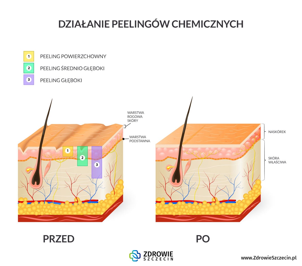 Peelingi chemiczne Szczecin, medycyna estetyczna Szczecin